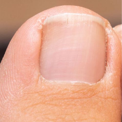After Treatment