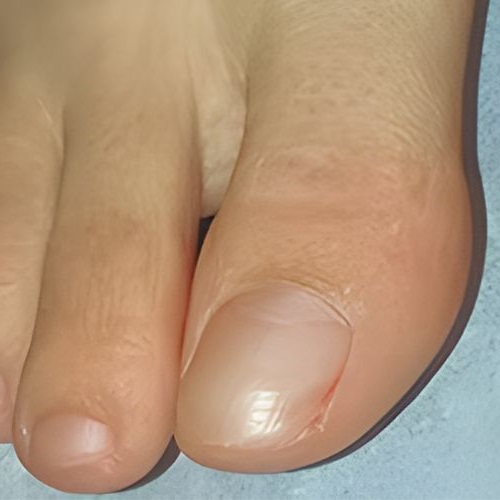 After Treatment