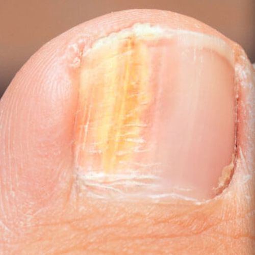 Before Treatment